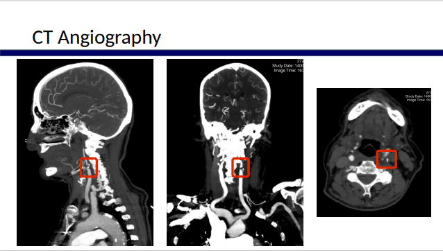 Ct Angiography World Stroke Academy 7296